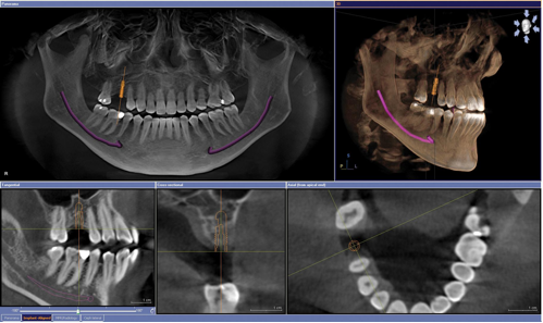 dentalscan 3d